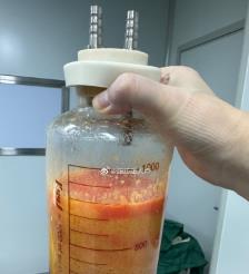 江苏水动力吸脂手术要做多久？